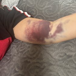 BioLife Plasma Services - This is 4 days after the incident and I'm still unable to pick my arm up(have limited mobility) and still painful.
