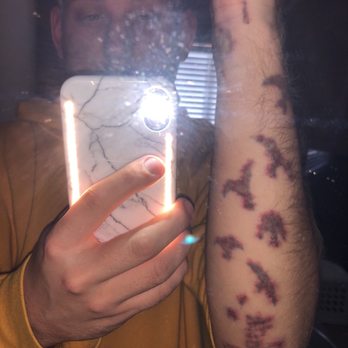 LaserAway - 10 sessions of "tattoo removal" - Medical Spas Near Me - Phoenix, Arizona