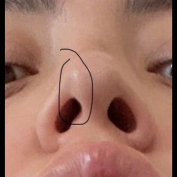 Vladimir Grigoryants, MD - Alar cartilages have map position. - Cosmetic Surgeons Near Me - Glendale, California Vladimir Grigoryants, MD - Alar cartilages have map position. - Cosmetic Surgeons Near Me - Glendale, California