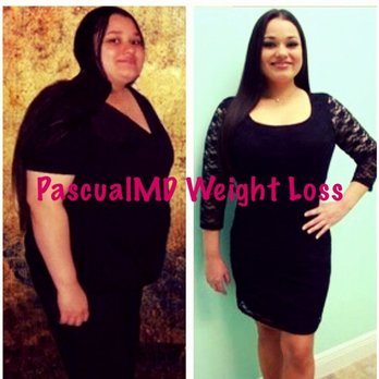 Amaryllis Pascual, MD - Lost 80 pounds in 3 months. - Cosmetic Surgeons Near Me