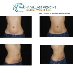 Marina Village Medicine - Coolsculpting before and after 1 treatment