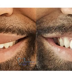 Riverview Dental - Smile makeover by Dr. Chowdhury at Riverview Dental--transforming smiles in Columbus, OH.