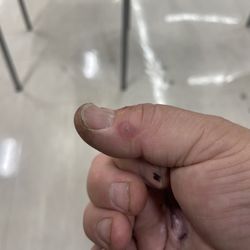 Urgent Care at Rancho Healthcare Center - Swelling from the infection from the cat bite...
