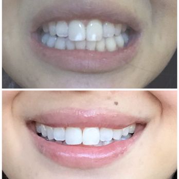 Bloom Dental Group - White spot treatment- Icon Resin Infiltration and teeth whitening - General Dentistry Near Me - San Mateo, California Bloom Dental Group - White spot treatment- Icon Resin Infiltration and teeth whitening - General Dentistry Near Me - San Mateo, California