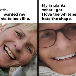 Norby Dental - Compare the shape. I asked for my implant to look like my original teeth.
