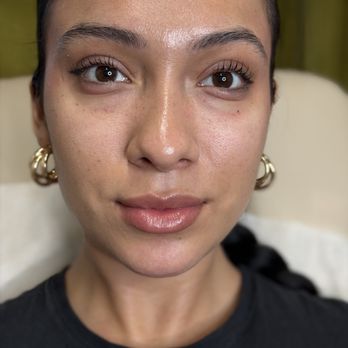 Ervin Beauty - Under eyes - Laser Hair Removal Near Me - Studio City, California