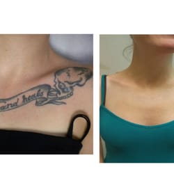 Laguna Laser Hair Removal & Aesthetics - Tattoo Removal