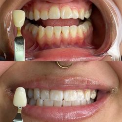 Bella Nova Teeth Whitening