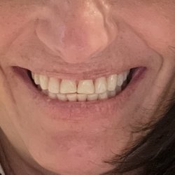 Braces off, ready to lengthen my front teeth.