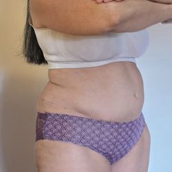 Virginia Institute of Plastic Surgery - Incision, in my opinion, is high, med rise underwear worn to get a good idea of incision height.
