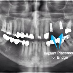 Pleasant Hill Dental Implant Center