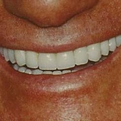 Alan Rosen DDS - Xpert Dental - AFTER PORCELAIN VENEERS