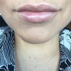 Hospitality Skin Spa & Aesthetics - Juvaderm lip fillers do wonders