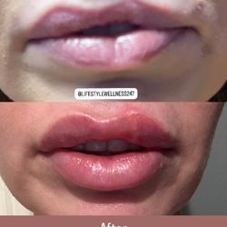 Lifestyle Health and Wellness - Lip filler with RHA