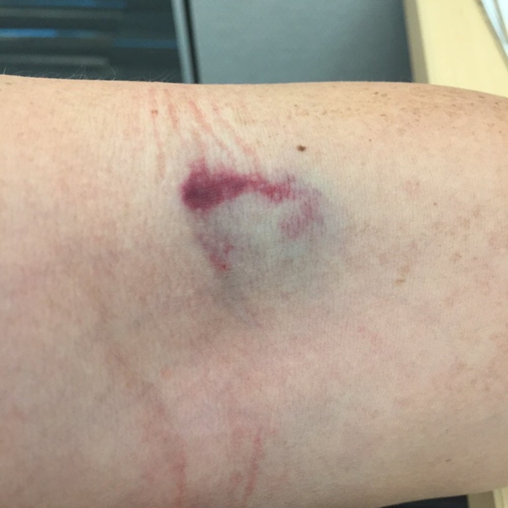 Quest Diagnostics - Bruise from my Blood Test- Day 1 - Laboratory Testing Near Me - Mountain View, California Quest Diagnostics - Bruise from my Blood Test- Day 1 - Laboratory Testing Near Me - Mountain View, California