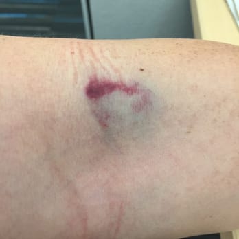 Quest Diagnostics - Bruise from my Blood Test- Day 1 - Laboratory Testing Near Me - Mountain View, California