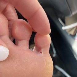 Kim's Nails - Puncture wound from pedicure