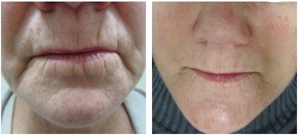 Stem cell Aging Expert - This stem cell skin firm, wrinkle free. Natural without down time is excellent for mature skin. Stem cell from bone narrow, keep skin young naturel glow beautiful we will experience the best of the best anti aging face lifting ever. Great for hyper pigmentation treatments, wrinkle mouths, eyes, firm neck and sagging skin, lifting eye lids drooping with Kim Van Stem cell serum . Stem cell Aging Expert - This stem cell skin firm, wrinkle free. Natural without down time is excellent for mature skin. Stem cell from bone narrow, keep skin young naturel glow beautiful we will experience the best of the best anti aging face lifting ever. Great for hyper pigmentation treatments, wrinkle mouths, eyes, firm neck and sagging skin, lifting eye lids drooping with Kim Van Stem cell serum .