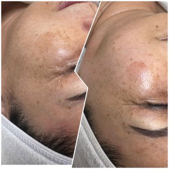 Rare Beauty - Dermaplaning Before + After - Skin Care Near Me - Waipahu, Hawaii Rare Beauty - Dermaplaning Before + After - Skin Care Near Me - Waipahu, Hawaii