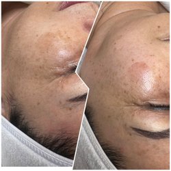 Rare Beauty - Dermaplaning Before + After