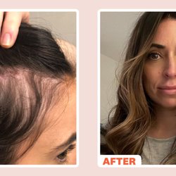 Sana Blue Med Spa - Hair Loss Treatments 6 sessions $599.00.