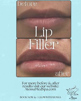 Lips Dermal Filler - Unlock red-carpet lips—elegantly sculpted by a Board-Certified Cardiologist in San Diego for those who demand the extraordinary.

Book Your Appointment Now!
https://www.myaestheticspro.com/BN/index.cfm?484571CC59E713CCDD9113D7979ED69E

Text Us: 
(858) 282-6722