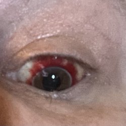 Silver State Eye Care - The eye looking much better over a month after it happened.