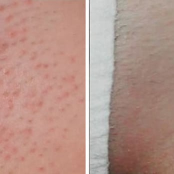 Before And After Laser Hair Removal No More Bumps Chafing