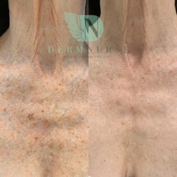 DermNurse Medical Aesthetics - Before and after of just one IPL treatment! The result is brighter healthier skin.
