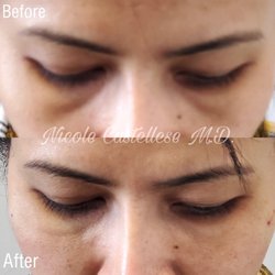 Institute for Beauty, Wellness & Regenerative Medicine - Tear Trough Filler