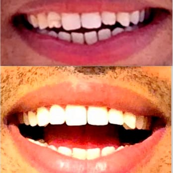 Floss - Restored: Eroded enamel of upper row - Cosmetic Dentists Near Me - San Diego, California