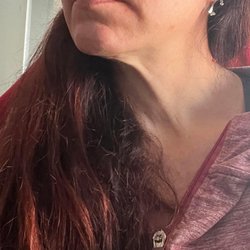 Cosmetic Plastic Surgery & Wellness Club - This is 8 months POST deep plane facelift and neck lift.
