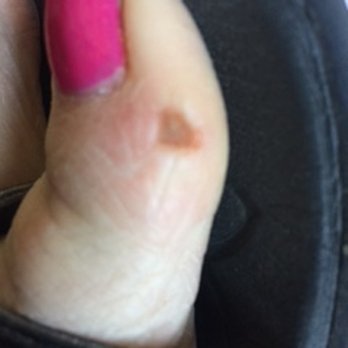 Nail Tek - Nail tech cut my toe....4 weeks later and I still can't wear closed shoes. Didn't offer a discount or anything. Going to the doctor soon! - Nail Salons Near Me - Charlotte, North Carolina Nail Tek - Nail tech cut my toe....4 weeks later and I still can't wear closed shoes. Didn't offer a discount or anything. Going to the doctor soon! - Nail Salons Near Me - Charlotte, North Carolina