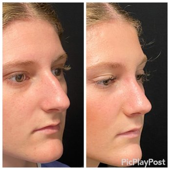 Ronald J Edelson, MD - Rhinoplasty before and after - Cosmetic Surgeons Near Me - San Diego, California Ronald J Edelson, MD - Rhinoplasty before and after - Cosmetic Surgeons Near Me - San Diego, California