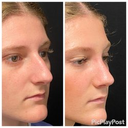 Ronald J Edelson, MD - Rhinoplasty before and after
