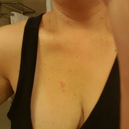 Bed. Bugs.