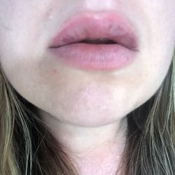 Bloom Facial Plastic Surgery - Bad, unusual blanching 2 days out. Left behind permanent discoloration (Tyndall effect) due to superficial placement.