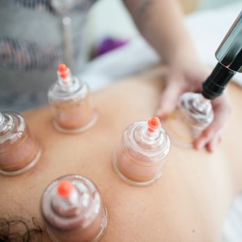 Kat Delse Mardirous, LAc. - Cupping is wonderful for back and shoulder pains. - Acupuncture Near Me - Santa Rosa, California Kat Delse Mardirous, LAc. - Cupping is wonderful for back and shoulder pains. - Acupuncture Near Me - Santa Rosa, California