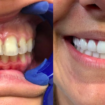 NÜVA Smile - Before & After at NÜVA Smile | East Brunswick, NJ - General Dentistry Near Me - East Brunswick, New Jersey NÜVA Smile - Before & After at NÜVA Smile | East Brunswick, NJ - General Dentistry Near Me - East Brunswick, New Jersey