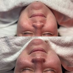 First Class Aesthetics - top photo was before the lymph drainage, bottom photo is after. My chin and everything immediately felt so much tighter and slimmer.