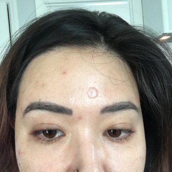 Agape - A very prominent scar on my forehead from the botched mole removal done at Agape. - Dermatologists Near Me - Providence, Rhode Island Agape - A very prominent scar on my forehead from the botched mole removal done at Agape. - Dermatologists Near Me - Providence, Rhode Island