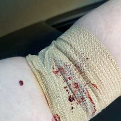 Biomat USA - The gauze had 2 layers of bandage over it so it overflowed with blood