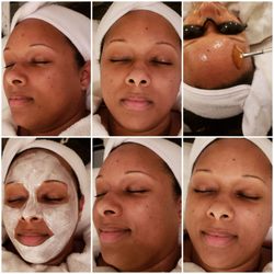 Crystal Pure Skin Care - Acid peel & Icy revitalizing Mask for Acne