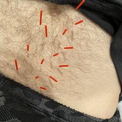 Michael Luong, Acupuncture & Traditional Chinese Medicine - Treating lower left back pain without placing needles on the back