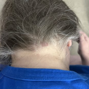 Trensy Nails Wax & Spa - A better view of some of the bruising on the back of my head. - Waxing Near Me - Omaha, Nebraska Trensy Nails Wax & Spa - A better view of some of the bruising on the back of my head. - Waxing Near Me - Omaha, Nebraska