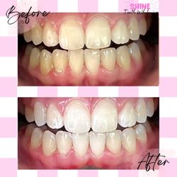 Shine Teeth Whitening - Before and after