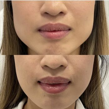 OrangeTwist - Jawline slimming achieved with Botox to the masseters. Did you know this treatment also prevents teeth grinding aka TMJ?! - Medical Spas Near Me - Santa Clara, California OrangeTwist - Jawline slimming achieved with Botox to the masseters. Did you know this treatment also prevents teeth grinding aka TMJ?! - Medical Spas Near Me - Santa Clara, California