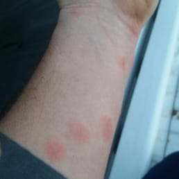 Bed Bug Bites..... Rm #143......Stay Away!!!!!
