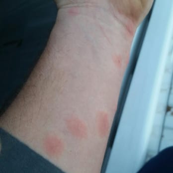 Budget Inns - Bed Bug Bites..... Rm #143......Stay Away!!!!! - Hotels Near Me - Tucumcari, New Mexico