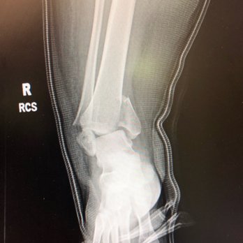 Ross H. Talarico, DPM - My broken ankle. - Orthopedists Near Me - Oakland, California Ross H. Talarico, DPM - My broken ankle. - Orthopedists Near Me - Oakland, California